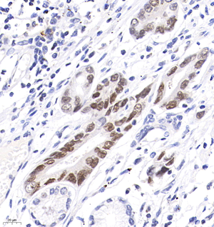 04 GB121501_20220520_CDX2_4A11F9_4A11F9 20220505 H gastric carcinoma d1000_IHC_40.0x.png