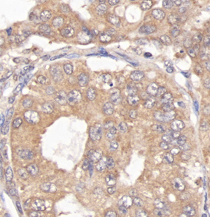 03 GB114592_20220717_LIMD1_12612_1261221083102 H endometrial cancer d600_40.0x_IHC.png