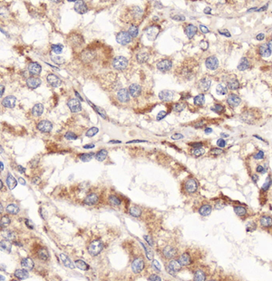 04 GB114592_20220717_LIMD1_12612_1261221083102 H renal carcinoma d600_40.0x_IHC.png