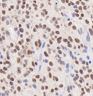 02 GB114593_20220717_MYEF2_12615_1261521083102 H glioblastoma multiforme d1800_40.0x_IHC.png