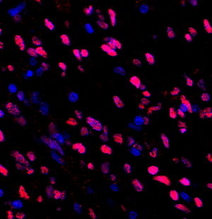 07 GB114593_202200714_MYEF2_12615_1261521083102 H glioblastoma multiforme d900_40.0x_IF.png