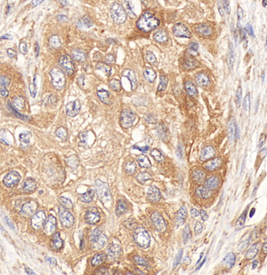 02 GB114601_20220717_ANXA9_12627_1262721091302 H esophageal squamous cell carcinoma d1400_40.0x_IHC.png