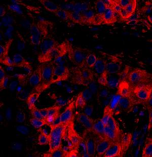 03 GB114601_202200714_ANXA9_12627_1262721091302 H esophageal squamous cell carcinoma d700_40.0x_IF.png