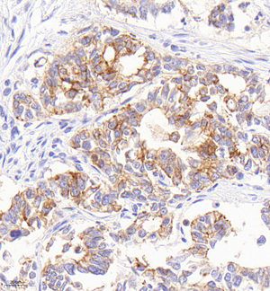 03 GB12067_20221008_claudin18.2_4B3F7_4B3F7 20220905 H gastric carcinoma d500_40.0x_IHC.jpg