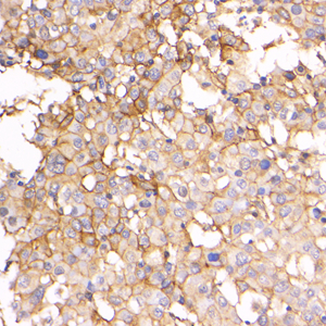 01 GB115048_20221024_MET_C254322080202 H liver cancer d600_40x_IHC_.jpg