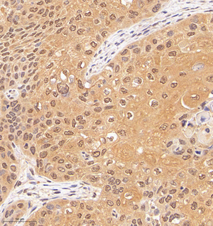 01 GB114987_20221010_MED22_13146_1314622030202 H esophageal carcinoma d800_30.0x_IHC.jpg