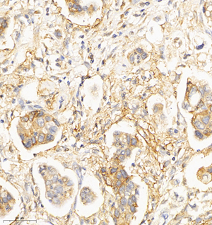 01  GB114563_20220908_DPYSL5_12573_1257321081702 H gastric cancer d800_IHC_30.0x.jpg