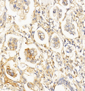 02  GB114563_20220908_DPYSL5_12573_1257321081702 H gastric cancer2 d800_IHC_30.0x.jpg
