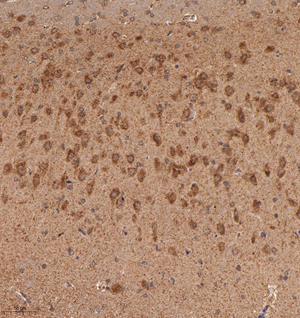 02 GB115083_20221010_MVD_13331_1333122042102 R brain cancer d600_20.0x_IHC.jpg