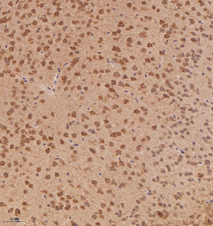 03 GB115083_20221010_MVD_13331_1333122042102 M brain cancer d600_20.0x_IHC.jpg