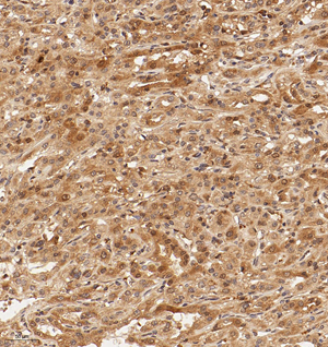 01 GB115086_20221010_VRK2_13339_1333922042102 H renal carcinoma d600_20.0x_IHC.jpg