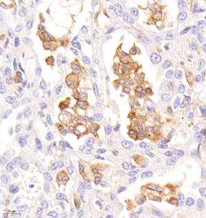 02 20221202_CD206_C1766_C176622091401 H lung adenocarcinoma d300_40.0x_IHC.jpg