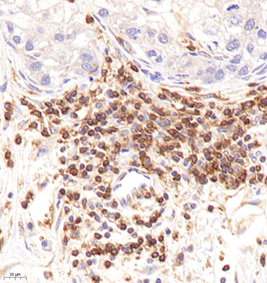 04 20221206_CD2_C2455_C245522082303 H lung adenocarcinoma d2800_40.0x_IHC.jpg