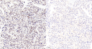 02  GB114585_20220523_P-JAK2_P-C1353_P-C135321110902 H lung adenocarcinoma  d650_20.0x_IHC.jpg