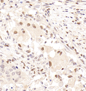 02 GB115296_2023.01.15_Histone H1.2_13846_1384622062402 H esophageal carcinoma d800_40.0x_IHC.jpg