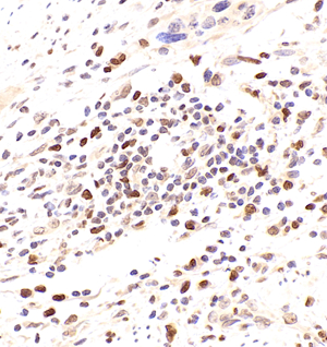 03 GB115296_2023.01.15_Histone H1.2_13846_1384622062402 H colon cancer d800_40.0x_IHC.jpg