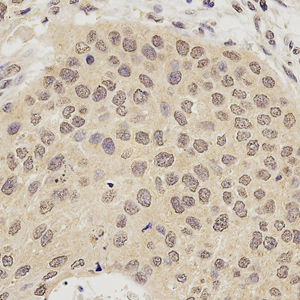 05 GB115301_20230201_ACAP3_13774_1377422062402 H esophageal carcinoma d1500_40x_IHC.jpg