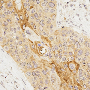 04 GB115305_20230201_CLEC2A_13787_1378722062402 H esophageal carcinoma d700_40x_IHC.jpg