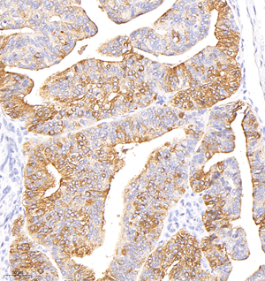 02 GB115321_20230110_CD227_C2347_C234722081602 H endometrial Cancer d500_20.0x_IHC.jpg
