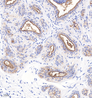 03 GB115321_20230110_CD227_C2347_C234722081602 H breast cancer d500_20.0x_IHC.jpg