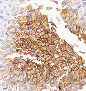 02 GB121184_20230214_CA-9_3G8D6_3G8D6 20221220 H renal carcinoma d1000_40.0x_IHC.jpg
