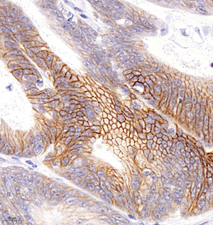 03 GB121184_20230214_CA-9_3G8D6_3G8D6 20221220 H colon cancer d1000_40.0x_IHC.jpg