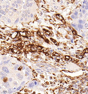 03 GB121308_20230214_vimentin_5D7F6_5D7F6 20221214 H esophageal carcinoma d1000_40.0x_IHC.jpg