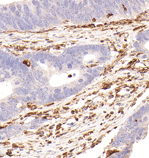 04 GB121308_20230214_vimentin_5D7F6_5D7F6 20221214 H colon cancer d1000_40.0x_IHC.jpg