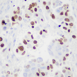 01 GB151141_20230216_ki67_C475_20230131 H ovarian cancer d500_40x_IHC.jpg