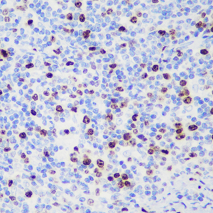 02 GB151141_20230216_ki67_C475_20230131 H tonsil d1000_40x_IHC.jpg