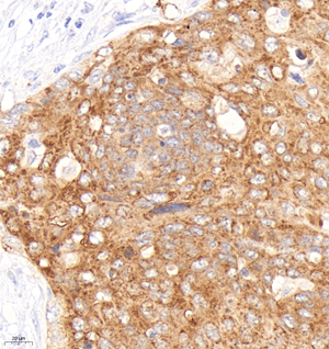 01 GB151176_20230102_HSPB1_GB151176_GB151176221114 H cervical carcinoma d1000_40.0x_IHC.jpg