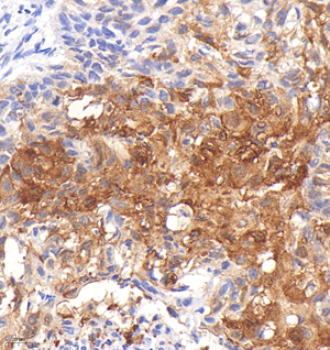 02 GB151176_20230102_HSPB1_GB151176_GB151176221114 H Keratosis squamous cell carcinoma of lung d1000_40.0x_IHC.jpg