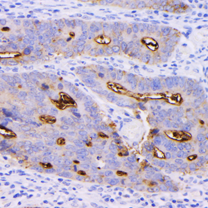 02 GB152292_20230131_CEA_C451_20221228 H colon cancer d1000_40x_IHC.jpg
