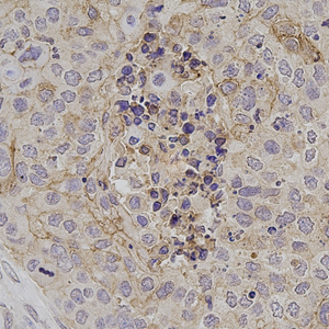 01 GB115331_20230214_ADAMTSL1_13860_1386022070802 H esophagus cancer d1000_40x_IHC.jpg