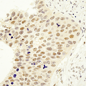 02 GB115337_20230214_FAM78B_13875_1387522070802 H esophageal cancer d1000_40x_IHC.jpg