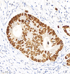 01 GB12626_20210627_GB12626 P53 H colorectal carcinoma d1000_30.0x_IHC.jpg