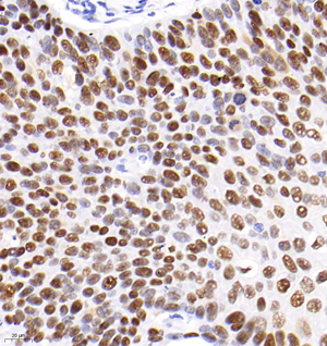 02 GB12626_20210623_GB12626 P53 H  esophageal cancer d1000_40.0x_IHC.jpg