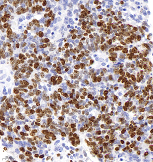 01 GB121499_202109010_ki67_GB121499 ki67 olfactory neuroblastoma d500_40.0x_IHC.jpg