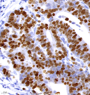 02 GB121499_202109010_GB121499 ki67 H colorectal carcinoma d500_40.0x_IHC.jpg