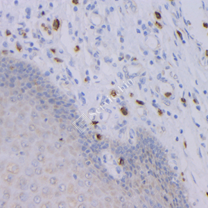 01 GB12092_20230420_GranzymeB_3D8A2_3D8A2 20230313 H Esophageal cancer d1000_IHC.jpg