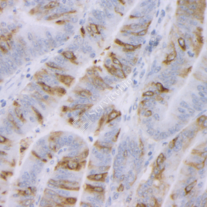 01 GB12344_20230420_muc2_1H3B9_1H3B9 20230228 H colon cancer d1000_IHC.jpg