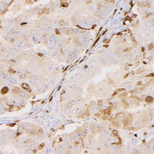 06 GB15398_20230419_S100A4_C45_C4520230403 H endometrial Cancer d1200_40.0x_IHC.jpg