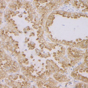 02 GB121011_20230420_NapsinA_3C2E4_3C2E4 20230304 H Lung cancer d1000_IHC.jpg