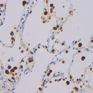 07 GB121011_20230420_NapsinA_3C2E4_3C2E4 20230304 H  Lung squamous cell carcinoma d1000_IHC.jpg
