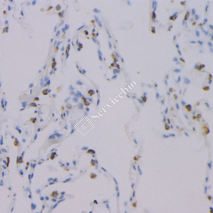 08 GB121011_20230420_NapsinA_3C2E4_3C2E4 20230304 H  lung adenocarcinoma d1000_IHC.jpg