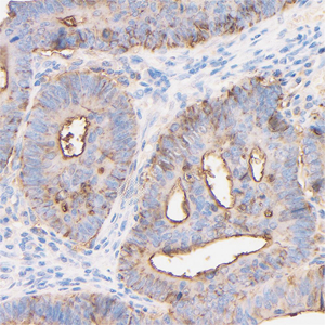 02 GB152293_20230419_CEACAM1_H49_H4920230403 H colon cancer d1000_40.0x_IHC.jpg