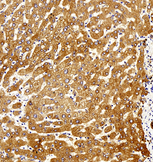 02 GB11009-1_Caspase-3_2016.5.24 H liver cancer caspase3 10716090702 d100_20.0x_IHC.jpg