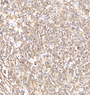 02 GB11061-1_20211019_CD19_S29521022003 H diffuse Large b-cell lymphoma d500_IHC_20x.jpg