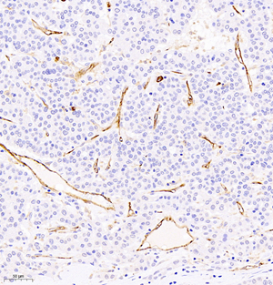 02 GB11063-2_CD31_411419061802 H liver cancer d600_20.0x_IHC.jpg