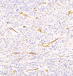 03 GB11063-2_CD31_411419061802 H liver cancer d600_20.1x_IHC.jpg